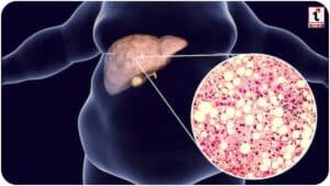 Fatty Liver Symptoms