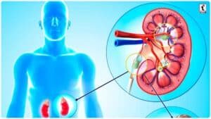 Kidney Stone Prevention