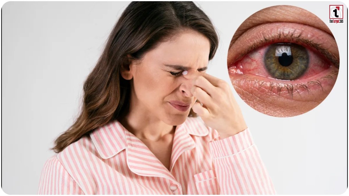 Conjunctivitis Symptoms