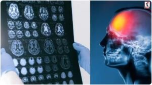 Brain Injury