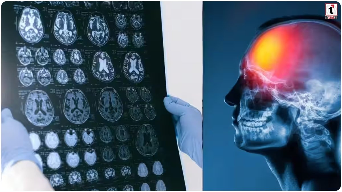 Brain Injury