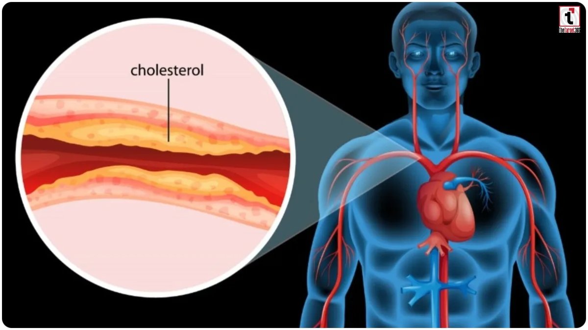 High Cholesterol Foods