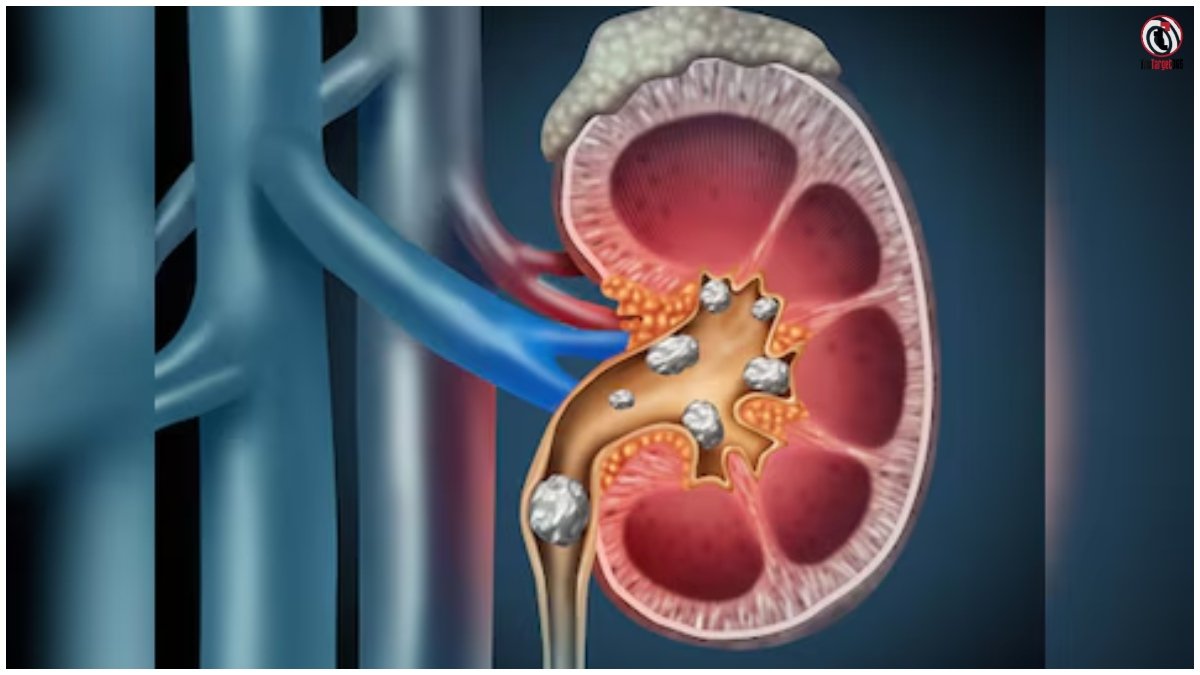 Kidney Stone