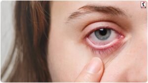 Monsoon Eye Care