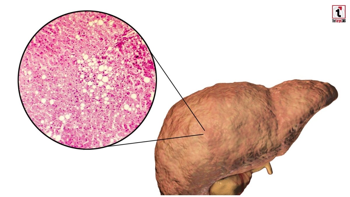 Fatty Liver Alert