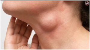Swollen Lymph Nodes