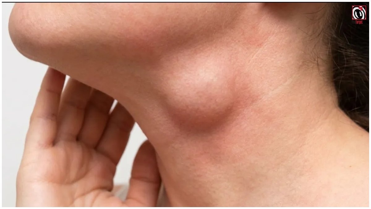 Swollen Lymph Nodes