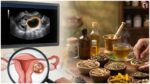 Ovarian Cyst: ओवेरियन सिस्ट क्या है? जानें कारण, प्रकार, लक्षण और इलाज के विकल्प