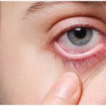 Eye Irritation