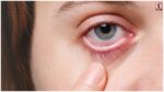 Eye Irritation