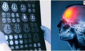 Brain Injury