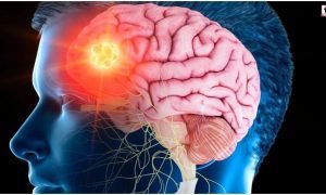 Brain Stroke Recovery