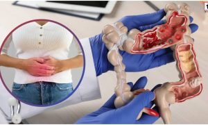 Colon Cancer