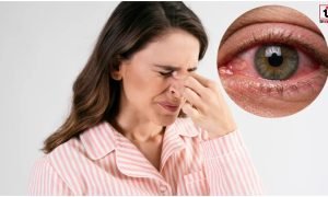 Conjunctivitis Symptoms