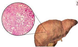 Fatty Liver Alert