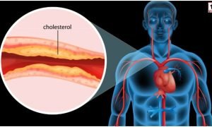 High Cholesterol Foods