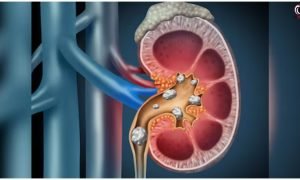 Kidney Stone