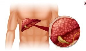 Liver Detox