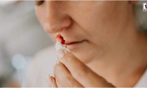 Nosebleed in Summer