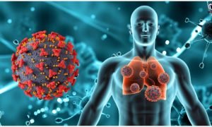 Swine Flu Pneumonia