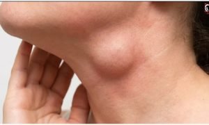Swollen Lymph Nodes