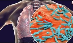 TB Awareness